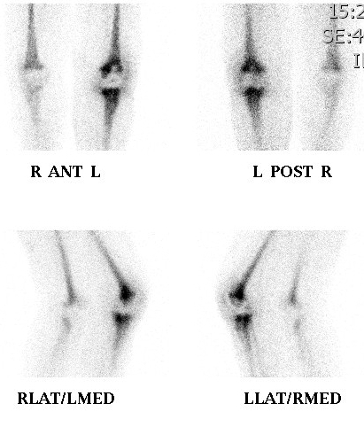 Leukocyte Scan